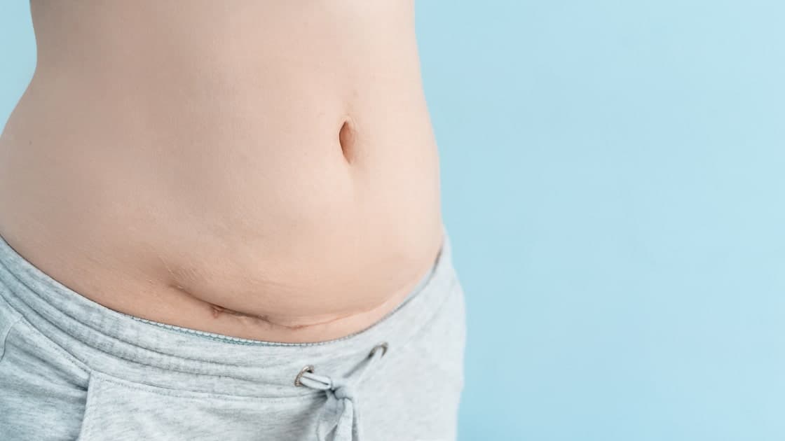 Що робити зі швами після пологів